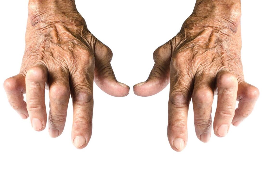artrito požymiai – sąnario deformacija