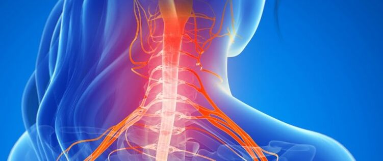 Nugaros smegenų kraujagyslių suspaudimas sergant kaklo stuburo osteochondroze