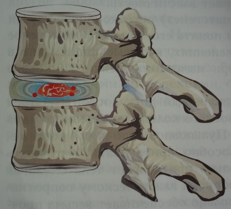 Tarpslankstelinio disko pulpos branduolio pažeidimas pirmojoje gimdos kaklelio osteochondrozės stadijoje