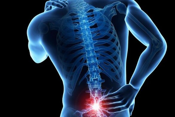 Ūmus apatinės nugaros dalies skausmas yra tarpslankstelinių diskų poslinkio simptomas