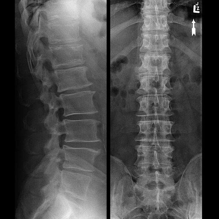 Stuburo snukis su osteochondroze